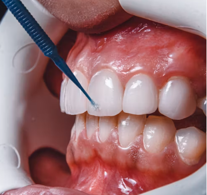 The Benefits of Teeth Whitening